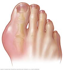 Image result for gout